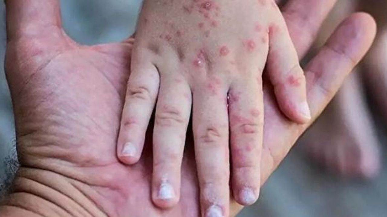 ABD'de ilk kez çocuklarda maymun çiçeği virüsü görüldü