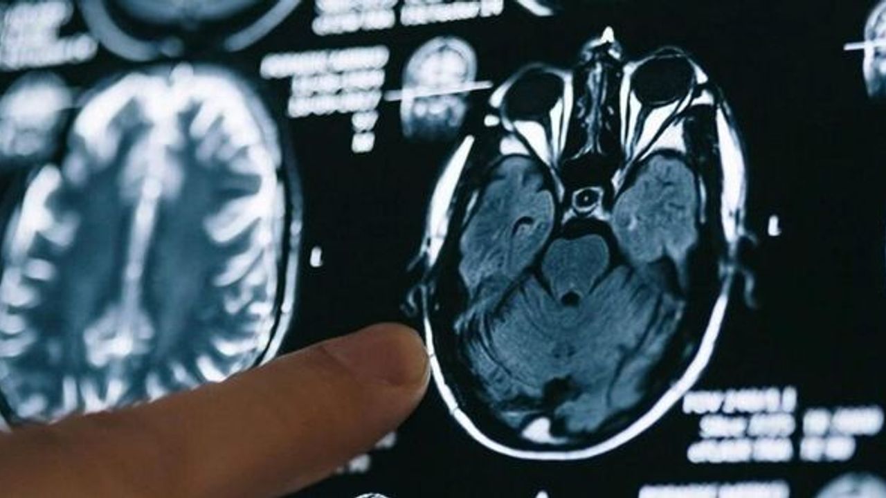 Nörologlar en genç Alzheimer hastasını teşhis etti