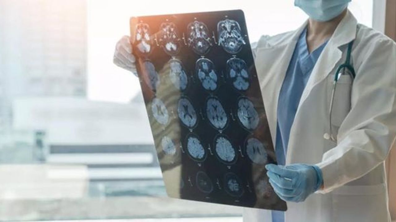 Alzheimer hastalığında yeni araştırma: Beyin hücreleri, nekroptoz geçiriyor